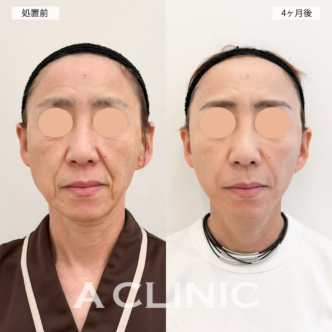 A式美肌たるみ切開で年齢と共に気になってくるほうれい線が改善されました！こちら処置前と4ヶ月後の症例です(60代女性)