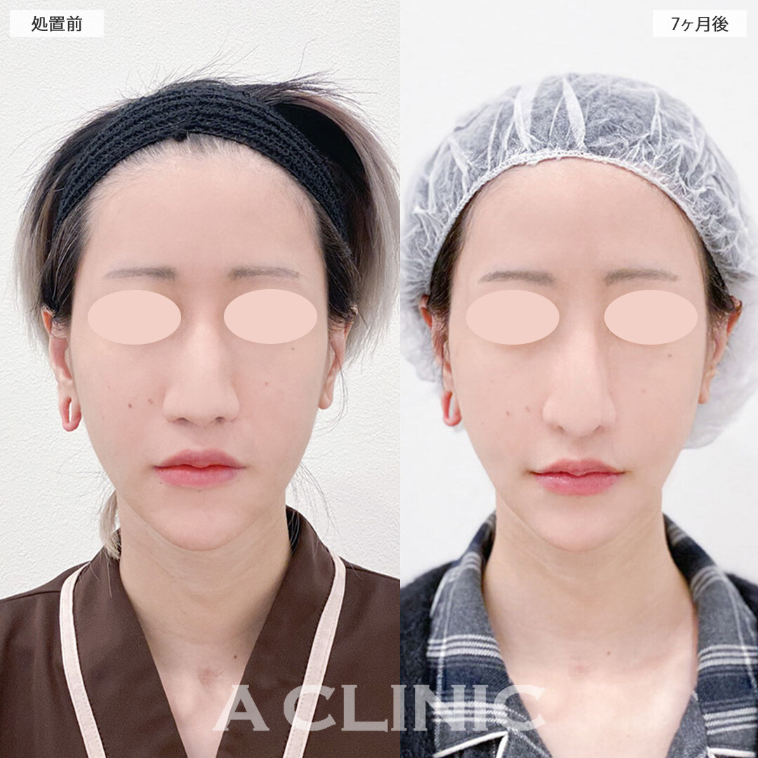 A式美肌たるみ切開でほうれい線が軽減しフェイスラインもスッキリしました！処置前と7ヶ月後の症例です(30代女性)