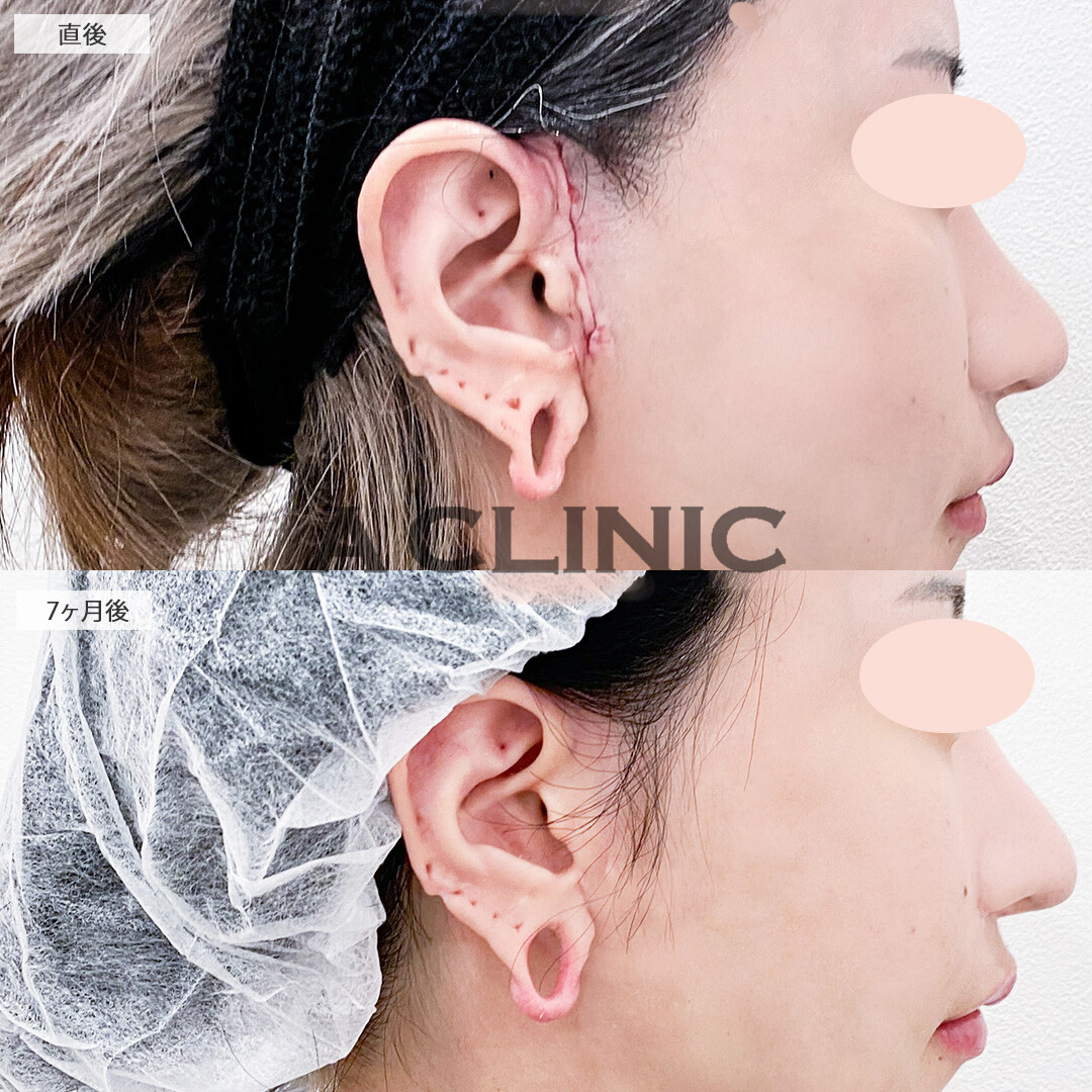 A式美肌たるみ切開でほうれい線が軽減しフェイスラインもスッキリしました！処置前と7ヶ月後の症例です(30代女性)