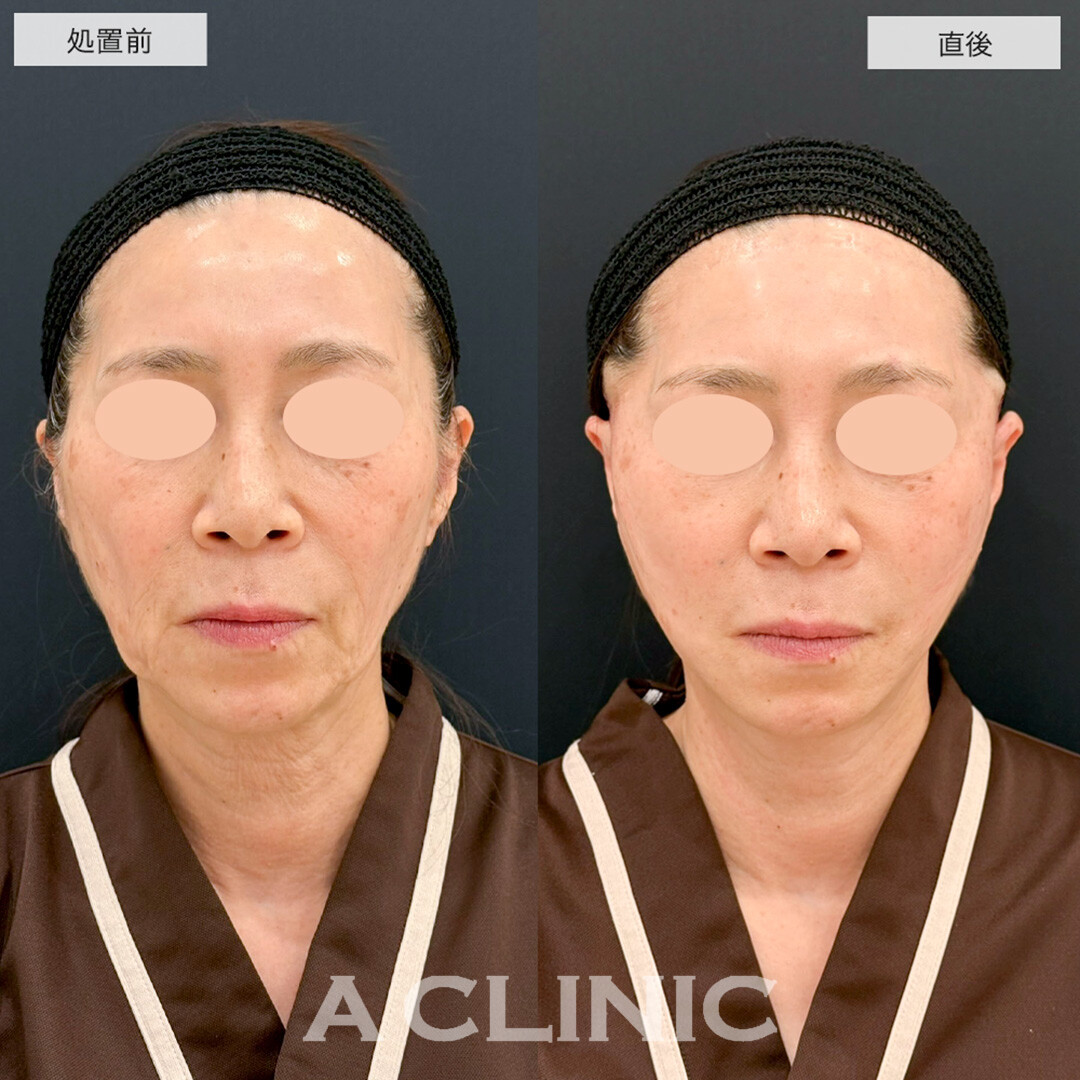 【直後の傷跡あり】A式美肌たるみ切開で顔のたるみを根本的に解決します!こちら処置前と直後の症例です(50代女性)