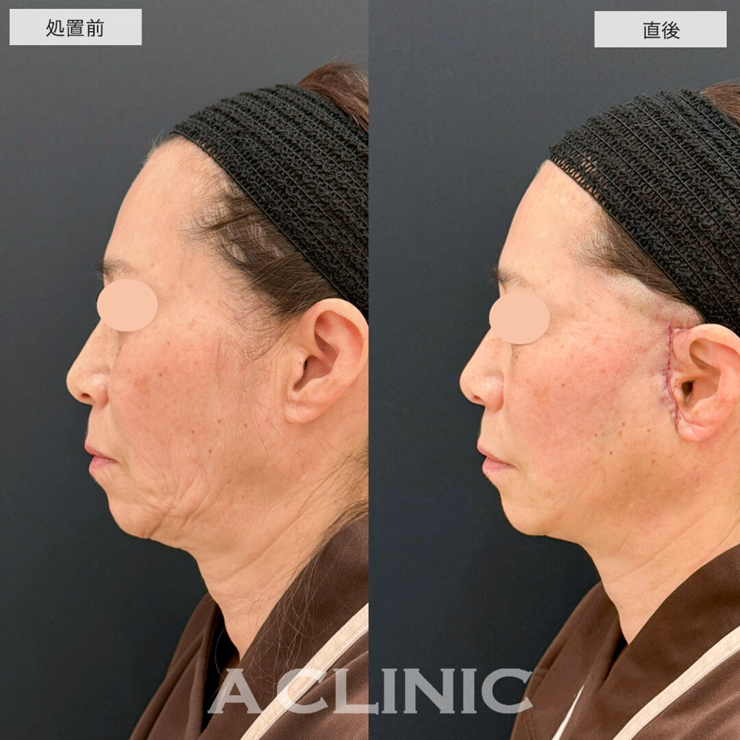 【直後の傷跡あり】A式美肌たるみ切開で顔のたるみを根本的に解決します!こちら処置前と直後の症例です(50代女性)