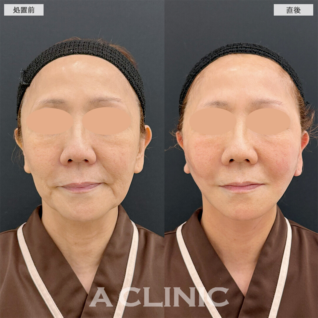 A式美肌たるみ切開で直後から綺麗な卵形輪郭へ！こちら処置前と直後の症例です(60代女性)