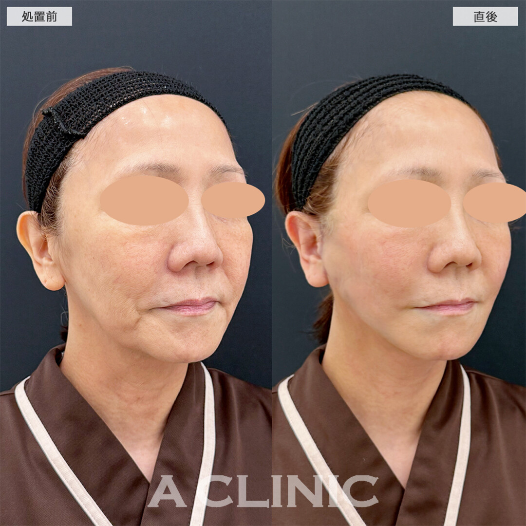 A式美肌たるみ切開で直後から綺麗な卵形輪郭へ！こちら処置前と直後の症例です(60代女性)