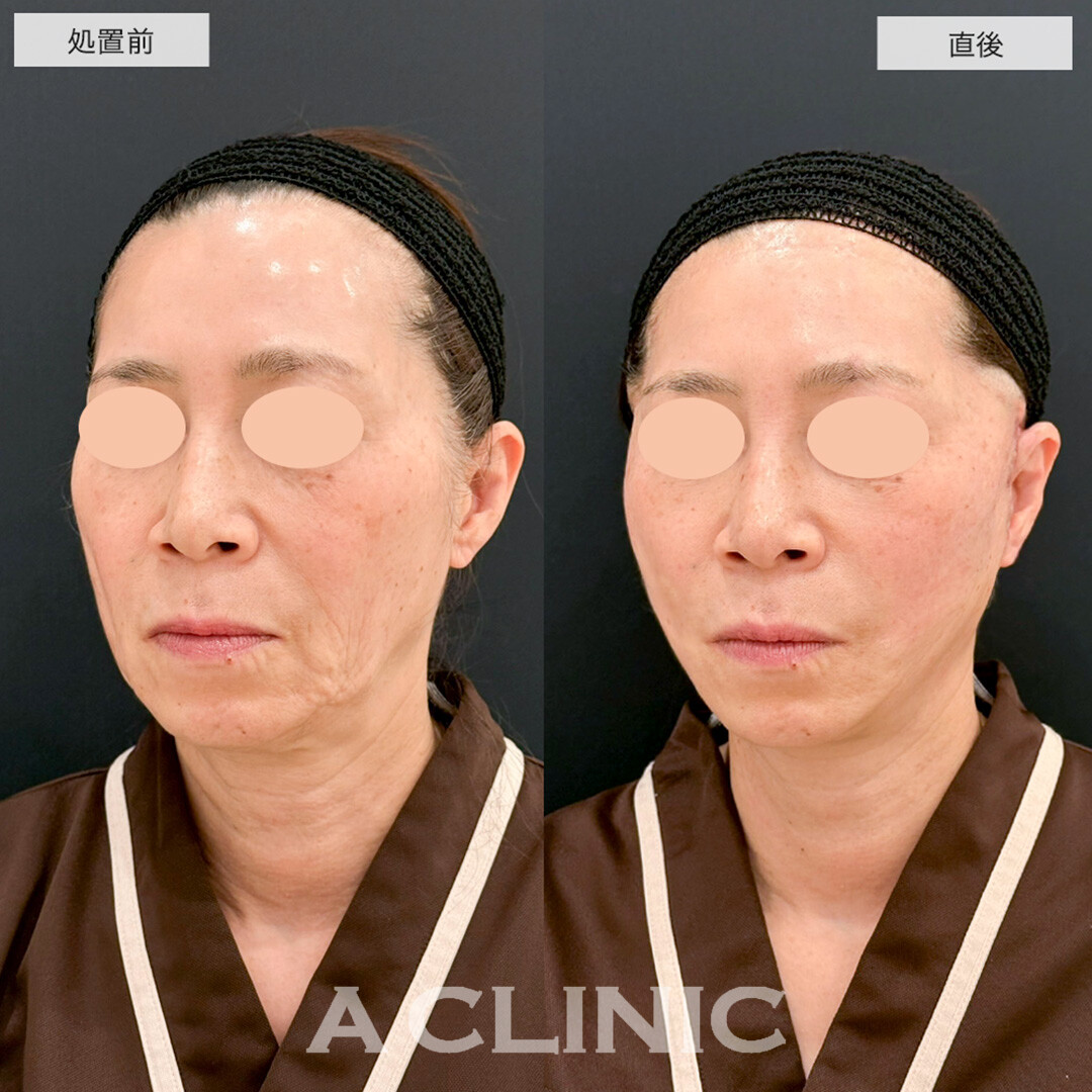 【直後の傷跡あり】A式美肌たるみ切開で顔のたるみを根本的に解決します!こちら処置前と直後の症例です(50代女性)