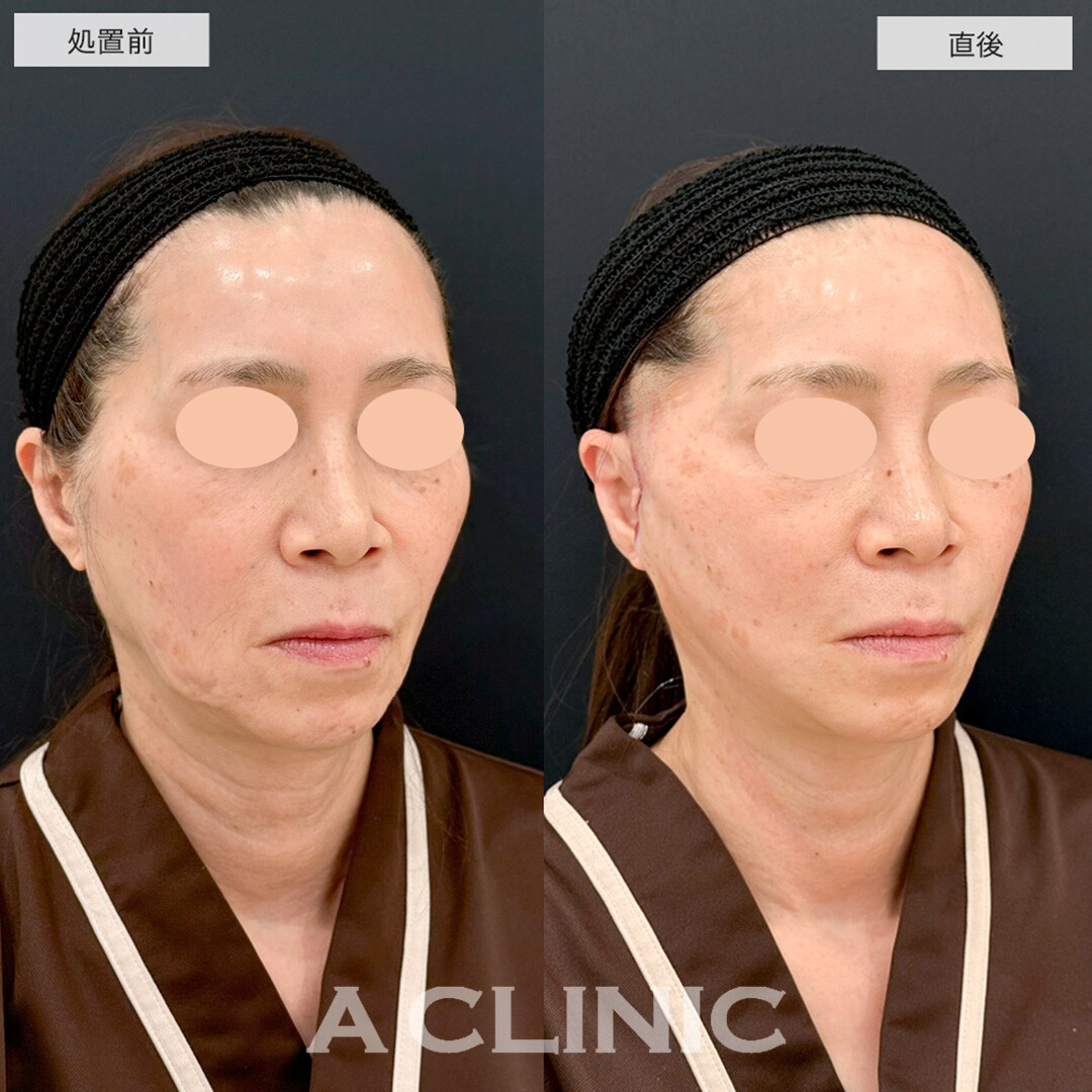 【直後の傷跡あり】A式美肌たるみ切開で顔のたるみを根本的に解決します!こちら処置前と直後の症例です(50代女性)