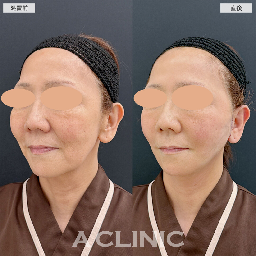 A式美肌たるみ切開で直後から綺麗な卵形輪郭へ！こちら処置前と直後の症例です(60代女性)
