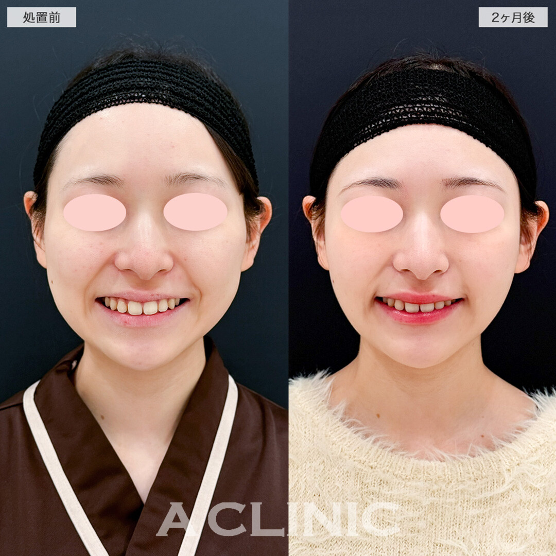 Aスレッドとバッカルファット除去術の併用で頬の厚みを抑えてナチュラルにリフトアップ！処置前と2ヶ月後の症例です(20代女性)
