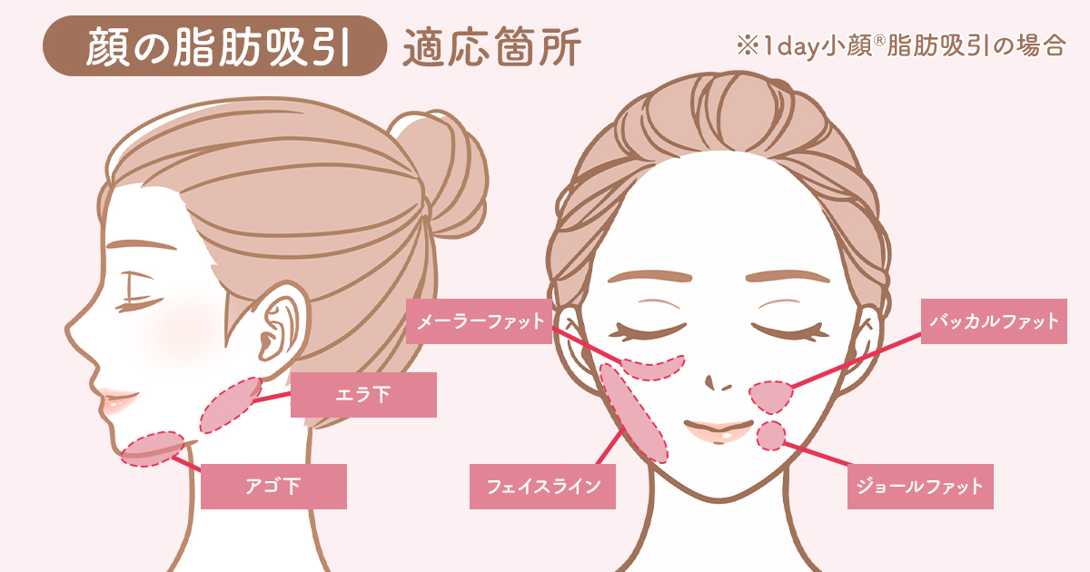 顔の脂肪吸引の施術部位