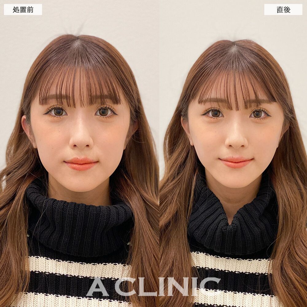 口横のもたつきを解消し理想の垢抜けフェイスに！Aスレッドの処置前と直後の症例です(20代女性)