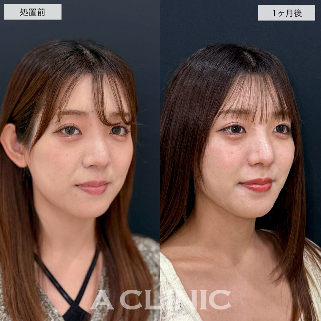 1day小顔脂肪吸引でリバウンドしない半永久の理想の輪郭に!こちら処置前と1ヶ月後の症例です(20代女性)