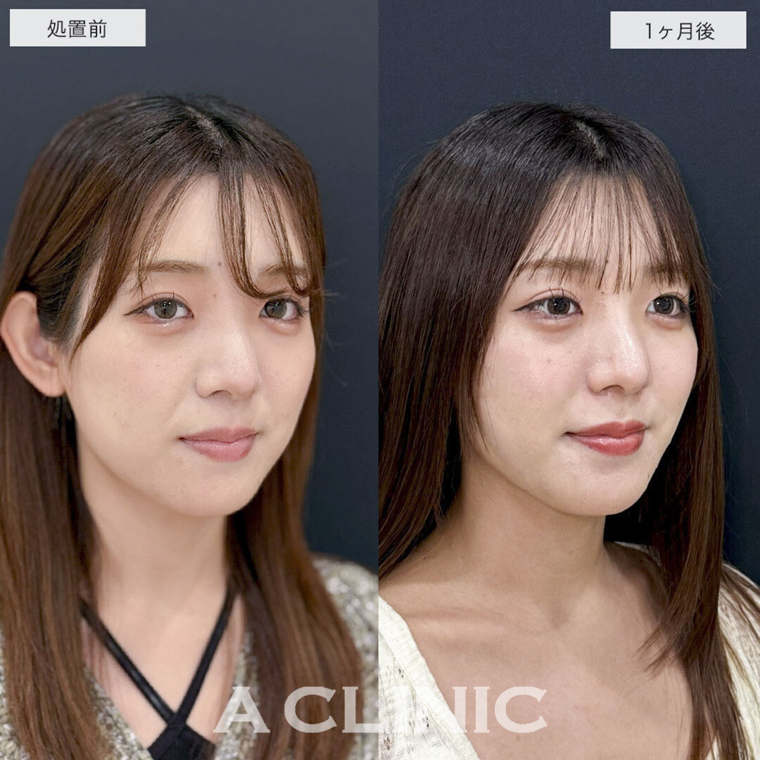 1day小顔脂肪吸引でリバウンドしない半永久の理想の輪郭に!こちら処置前と1ヶ月後の症例です(20代女性)