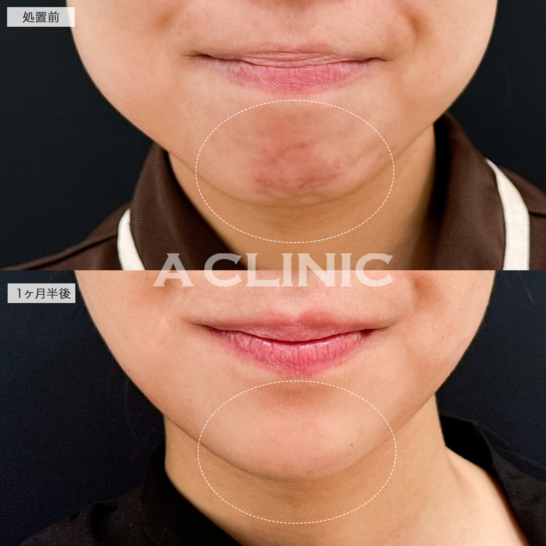 1day小顔脂肪吸引と小顔エラボトックスの組み合わせで綺麗な卵型輪郭爆誕!こちら処置前と1ヶ月半後の症例です(20代女性)