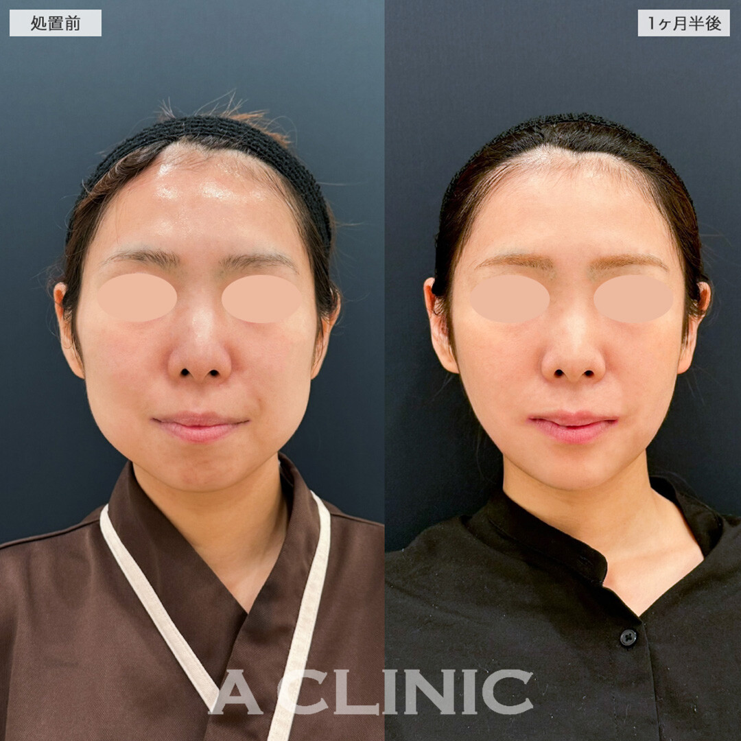 1day小顔脂肪吸引と小顔エラボトックスの組み合わせで綺麗な卵型輪郭爆誕!こちら処置前と1ヶ月半後の症例です(20代女性)