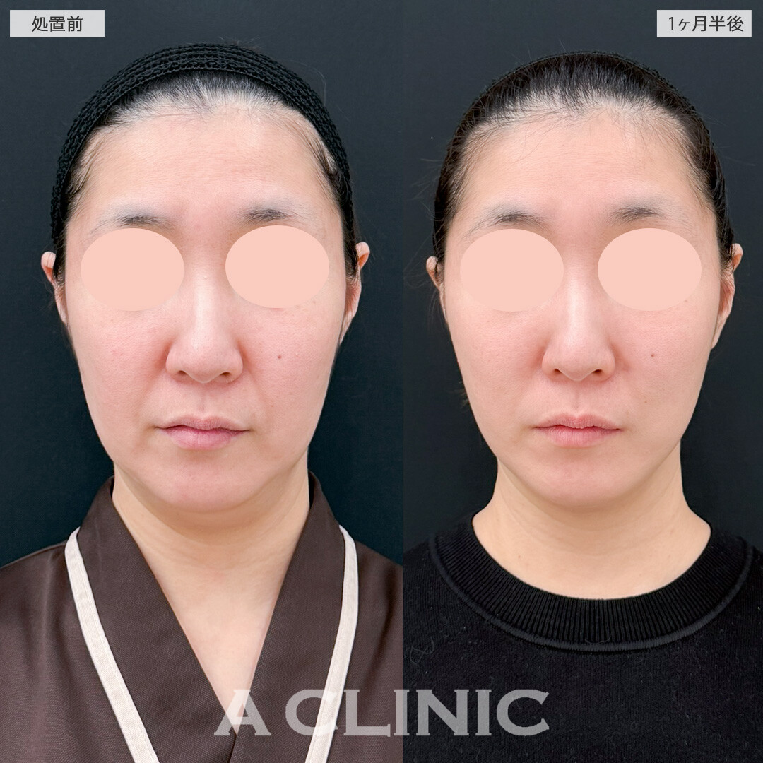 1day小顔脂肪吸引とナゾラビアルファット除去術でほうれい線解消とブルドッグ顔予防ができました！処置前と1ヶ月半後の症例です(30代女性)
