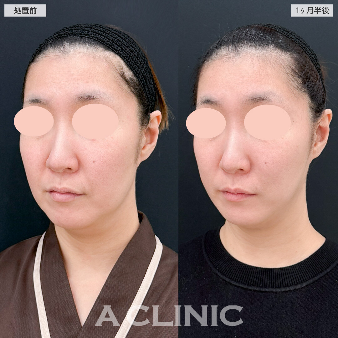 1day小顔脂肪吸引とナゾラビアルファット除去術でほうれい線解消とブルドッグ顔予防ができました！処置前と1ヶ月半後の症例です(30代女性)