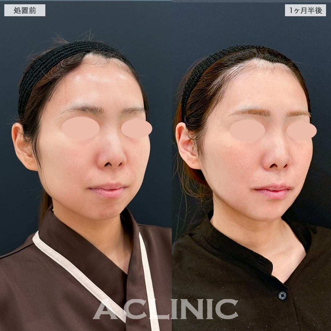 1day小顔脂肪吸引と小顔エラボトックスの組み合わせで綺麗な卵型輪郭爆誕!こちら処置前と1ヶ月半後の症例です(20代女性)