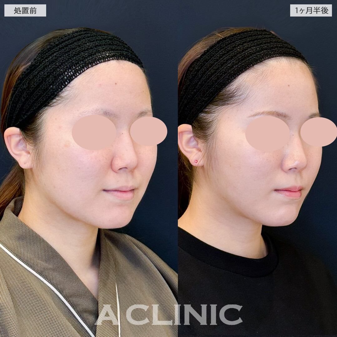 1day小顔脂肪吸引と小顔エラボトックスで不要な部分をピンポイントで除去してバランスの整ったフェイスに！処置前と１ヶ月半後の症例です(20代女性)