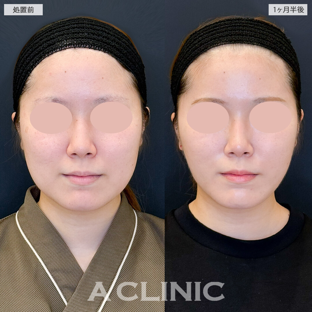 1day小顔脂肪吸引と小顔エラボトックスで不要な部分をピンポイントで除去してバランスの整ったフェイスに！処置前と１ヶ月半後の症例です(20代女性)