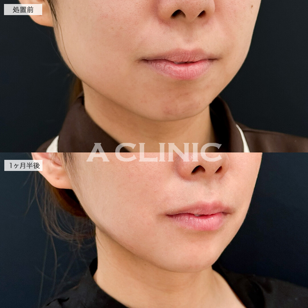 1day小顔脂肪吸引と小顔エラボトックスの組み合わせで綺麗な卵型輪郭爆誕!こちら処置前と1ヶ月半後の症例です(20代女性)