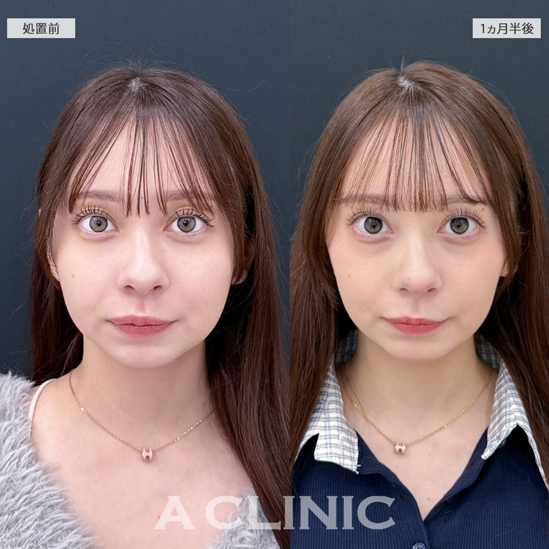 1day小顔脂肪吸引なら固定バンドなしでもスッキリ小顔に！こちら処置前と1ヵ月半後の症例です(10代女性)