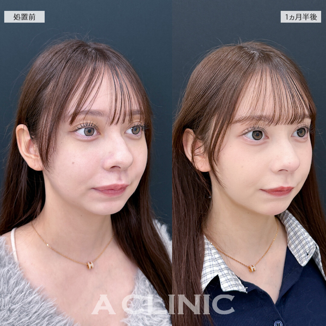 1day小顔脂肪吸引なら固定バンドなしでもスッキリ小顔に！こちら処置前と1ヵ月半後の症例です(10代女性)