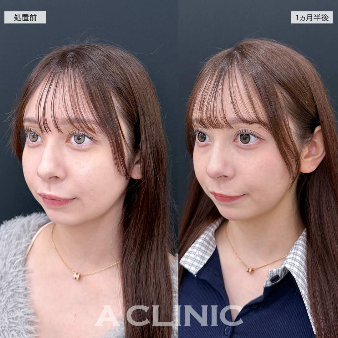 1day小顔脂肪吸引なら固定バンドなしでもスッキリ小顔に！こちら処置前と1ヵ月半後の症例です(10代女性)