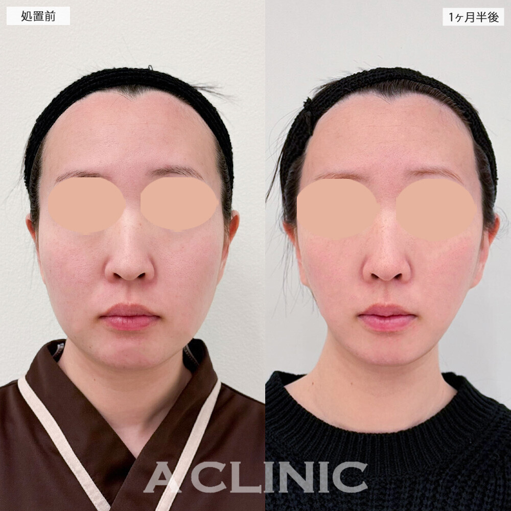 1day小顔脂肪吸引と小顔エラボトックスで口周りのもたつきがなくなり褒められる輪郭に！こちら処置前と1ヶ月半後の症例です(20代女性)