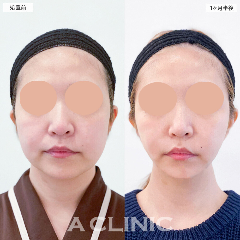 1day小顔脂肪吸引で丸顔から卵型へ！こちら処置前と1ヶ月半後の症例です(30代女性)