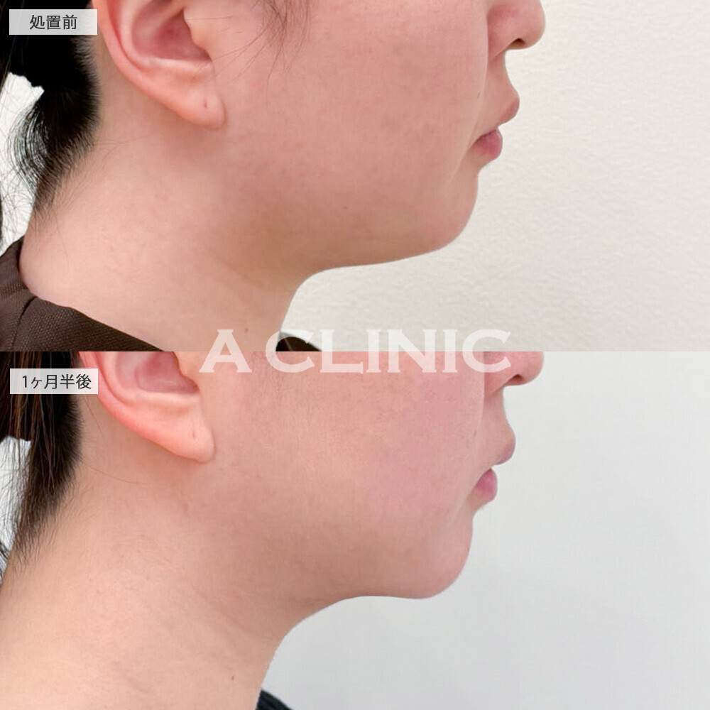 1day小顔脂肪吸引と小顔エラボトックスで口周りのもたつきがなくなり褒められる輪郭に！こちら処置前と1ヶ月半後の症例です(20代女性)