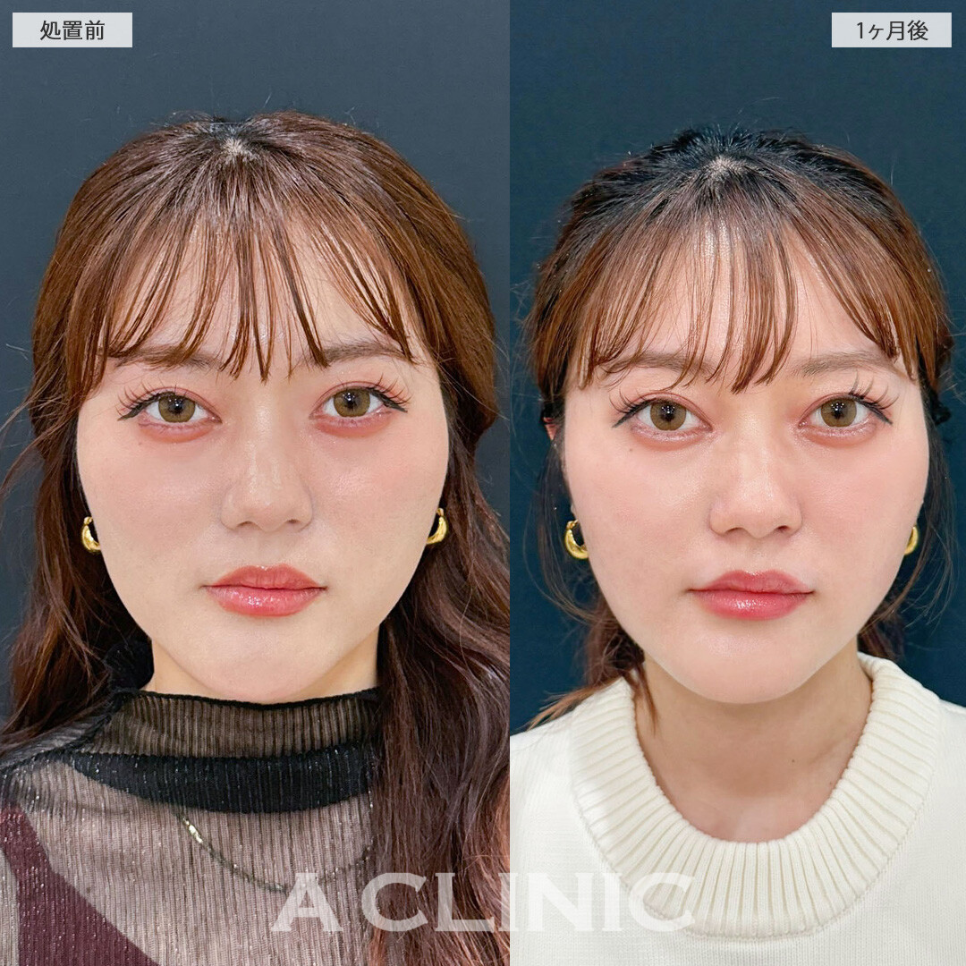 1day小顔脂肪吸引でホホのコケを治しつつ全体的にスッキリとしたフェイスラインになりました！処置前と1ヶ月後の症例です(20代女性)