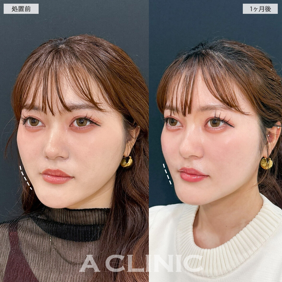 1day小顔脂肪吸引でホホのコケを治しつつ全体的にスッキリとしたフェイスラインになりました！処置前と1ヶ月後の症例です(20代女性)