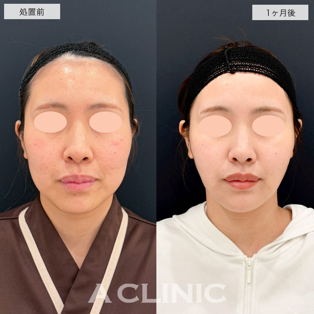 1day小顔脂肪吸引で憧れのインフルエンサーのような輪郭に!こちら処置前と1ヶ月後の症例です(30代女性)