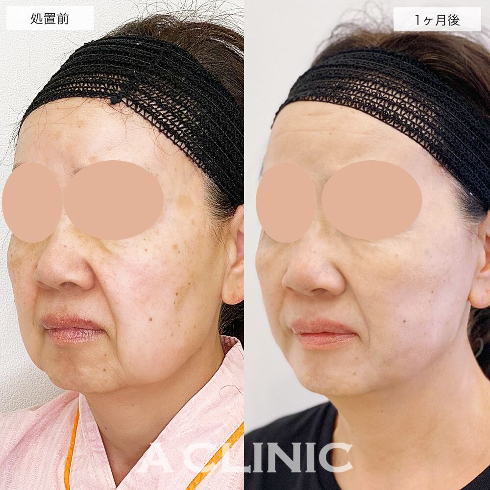 いつまでも若々しくいたい方にオススメ♪こちら1day小顔脂肪吸引の処置前と1ヶ月後の症例です(50代女性)