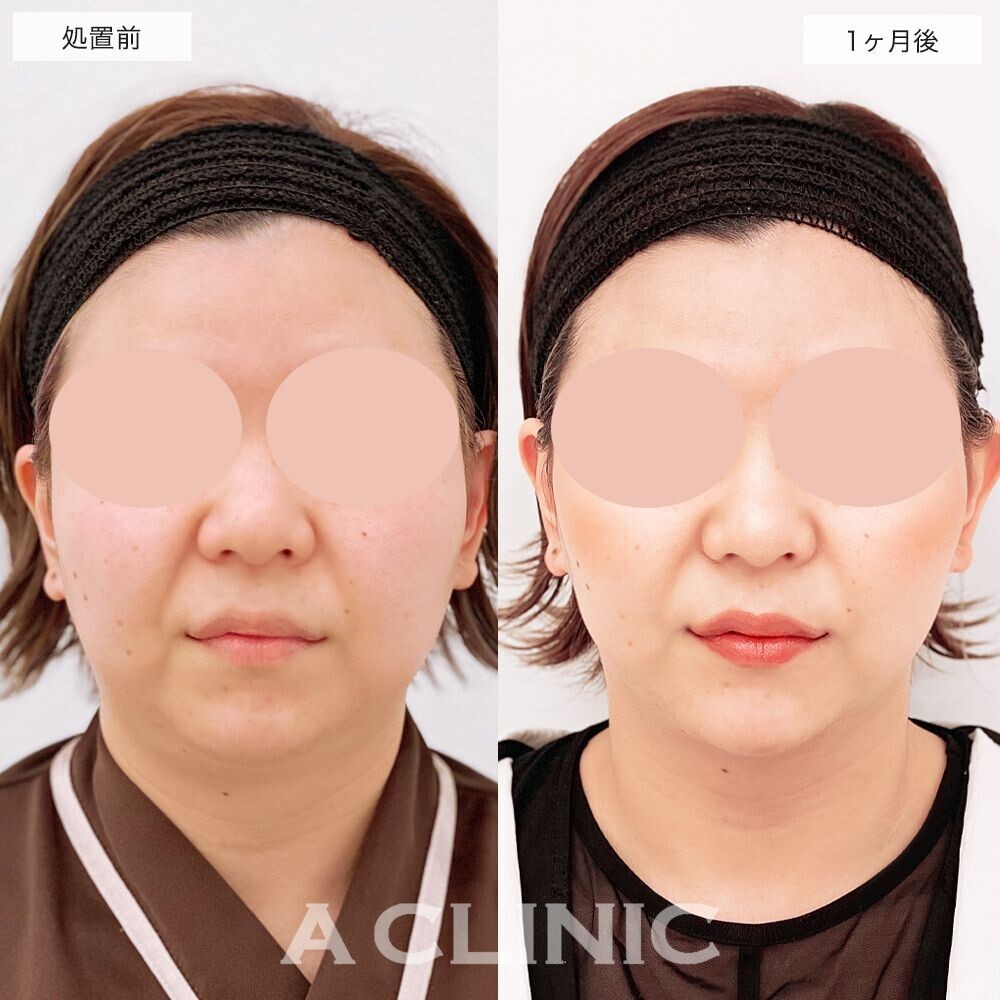 お顔のもたつきが軽減しスッキリとした輪郭に変化しました！1day小顔脂肪吸引の処置前と1ヶ月後の症例です(20代女性)