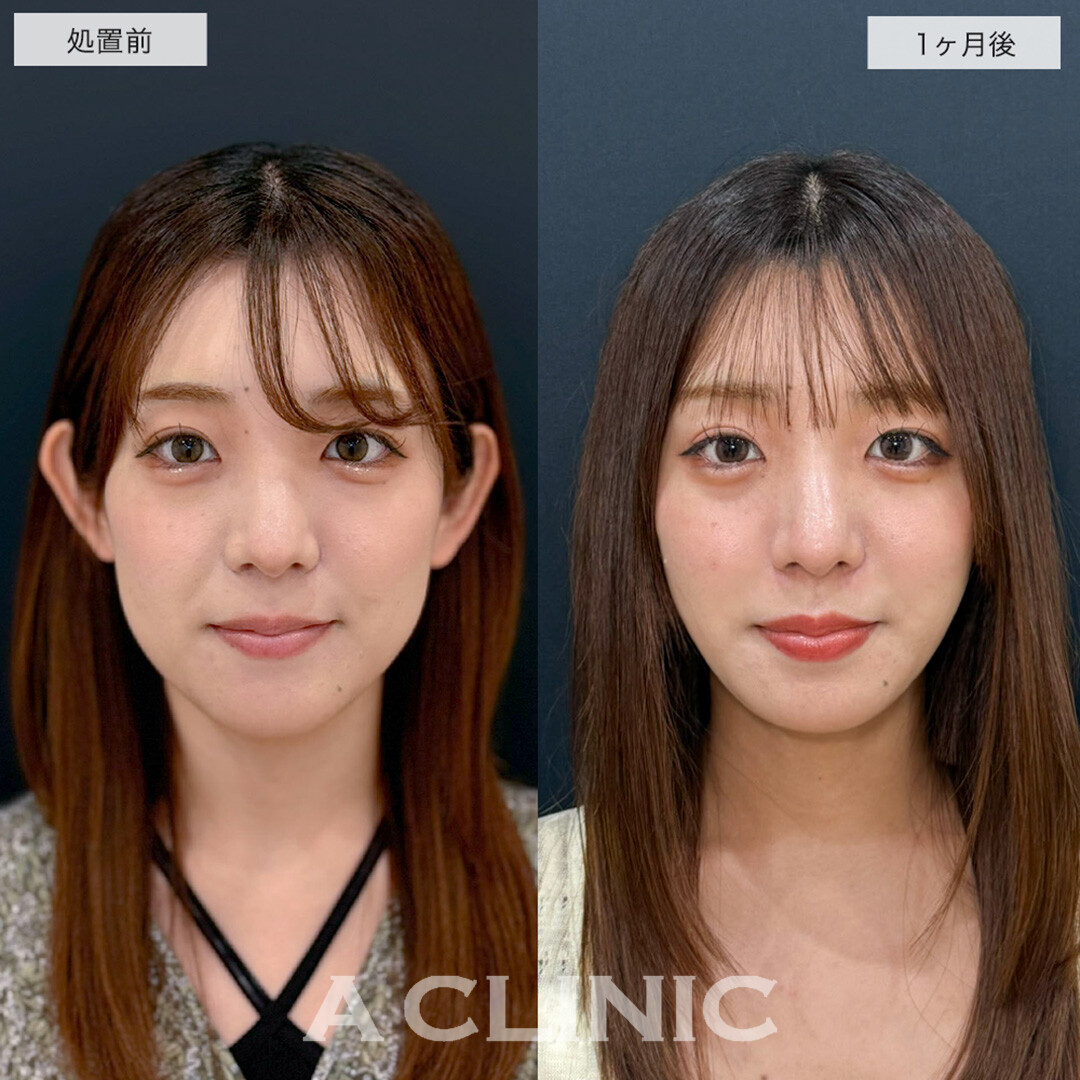 1day小顔脂肪吸引でリバウンドしない半永久の理想の輪郭に!こちら処置前と1ヶ月後の症例です(20代女性)