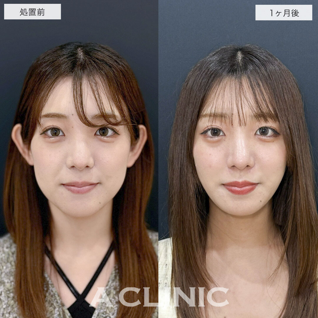1day小顔脂肪吸引でリバウンドしない半永久の理想の輪郭に!こちら処置前と1ヶ月後の症例です(20代女性)
