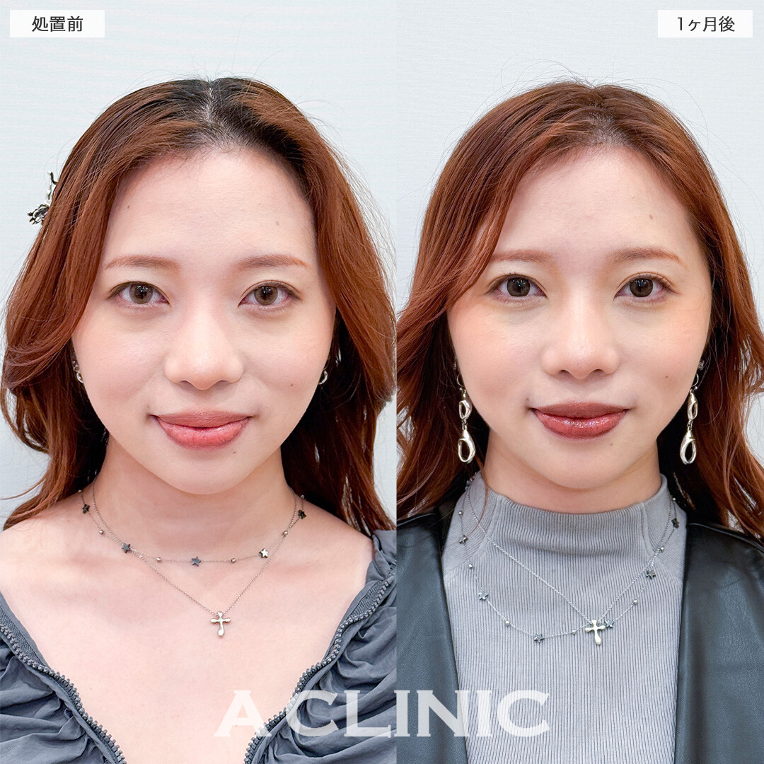 1day小顔脂肪吸引で全方向整ったフェイスラインへ！こちら処置前と1ヶ月後の症例です(30代女性)