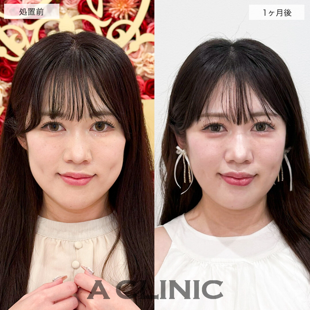 1day小顔脂肪吸引で下膨れ顔が改善し洗練された美人に!こちら処置前と1ヶ月後の症例です(30代女性)