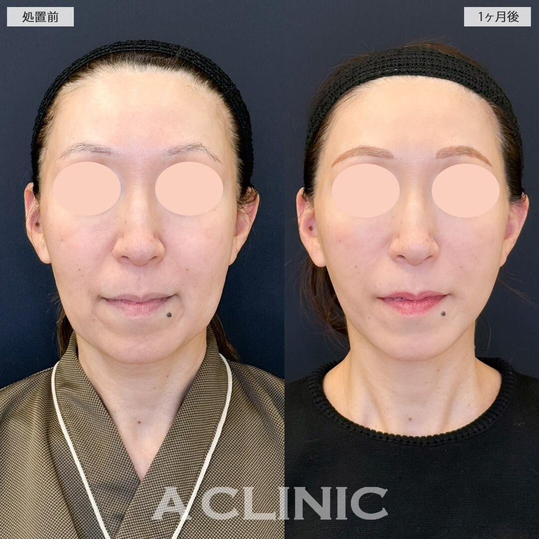 1day小顔脂肪吸引は輪郭のもたつきやたるみなどさまざまなお悩みを同時に改善できます！処置前と１ヶ月後の症例です(50代女性)
