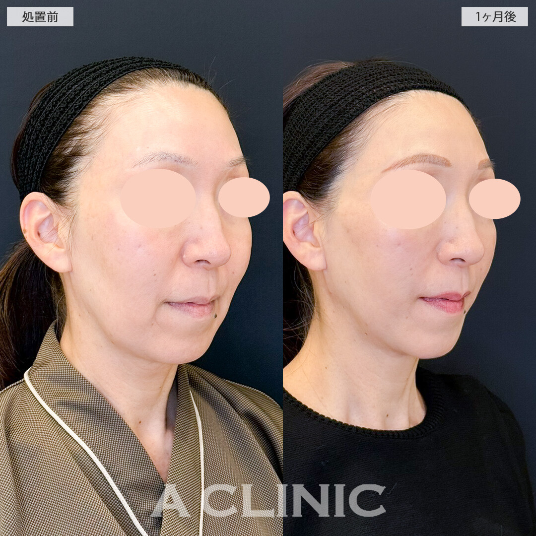 1day小顔脂肪吸引は輪郭のもたつきやたるみなどさまざまなお悩みを同時に改善できます！処置前と１ヶ月後の症例です(50代女性)