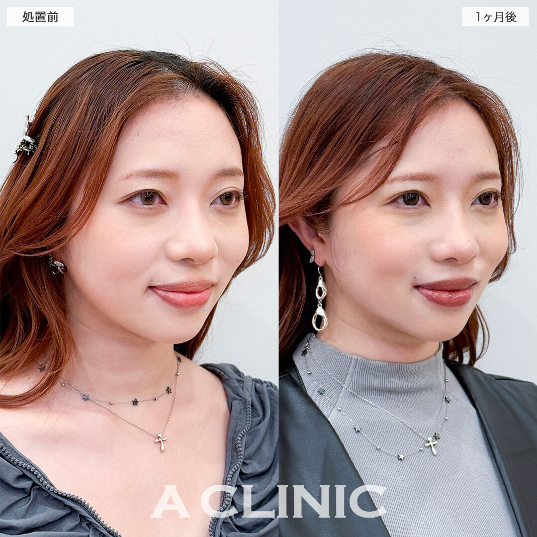 1day小顔脂肪吸引で全方向整ったフェイスラインへ！こちら処置前と1ヶ月後の症例です(30代女性)