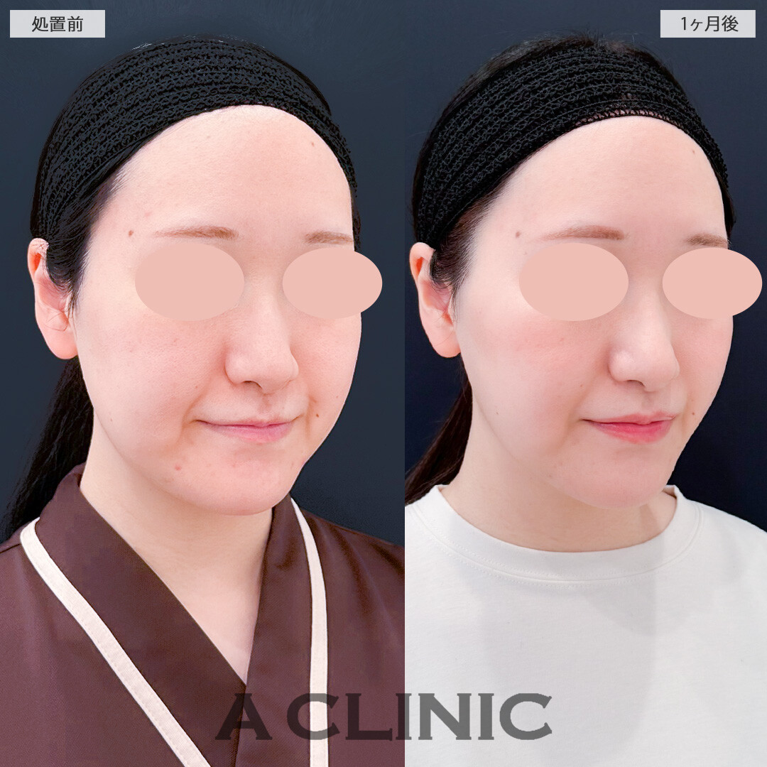 1day小顔脂肪吸引でたるみにくい卵型フェイスに変わりました！処置前と１ヶ月後の症例です(30代女性)