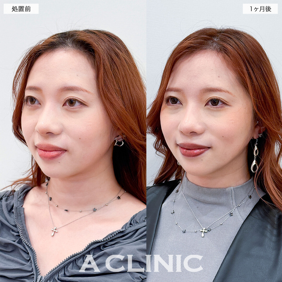 1day小顔脂肪吸引で全方向整ったフェイスラインへ！こちら処置前と1ヶ月後の症例です(30代女性)