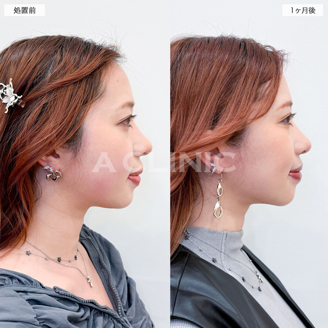 1day小顔脂肪吸引で全方向整ったフェイスラインへ！こちら処置前と1ヶ月後の症例です(30代女性)