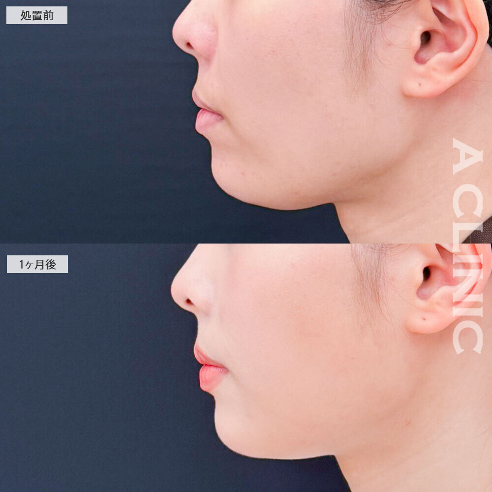 1day小顔脂肪吸引とボトックス注射(しわ)でクッキリ立体的な輪郭に！処置前から2ヶ月後の症例です(20代女性)