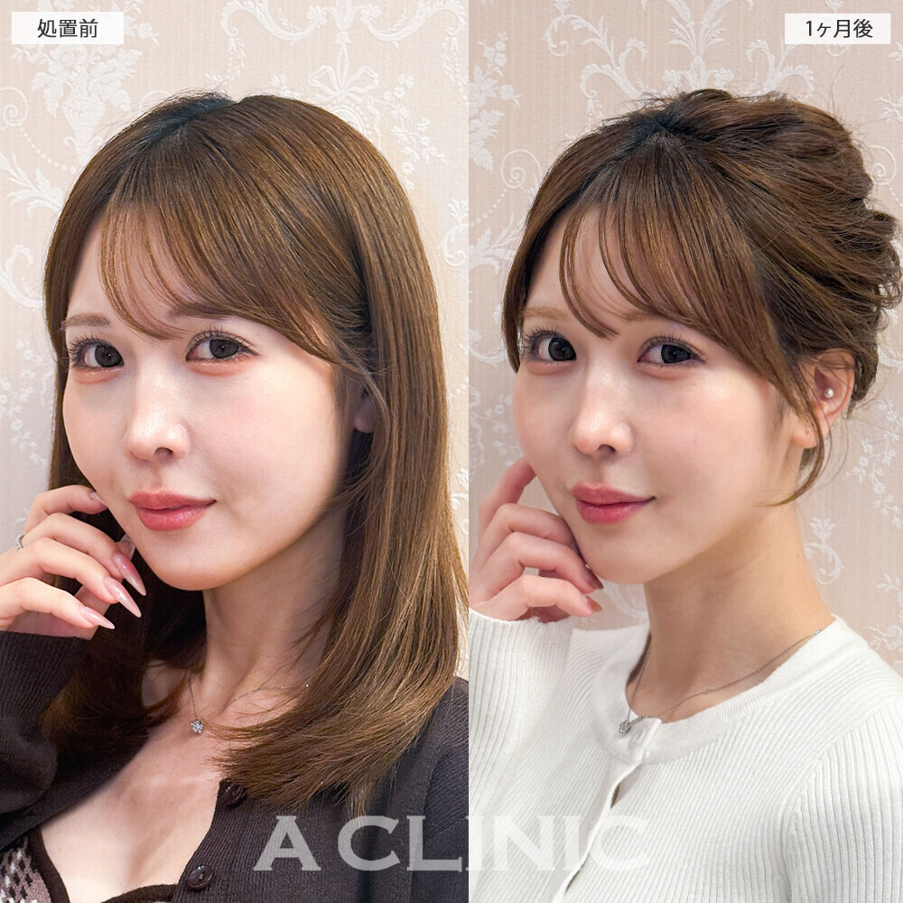 1day小顔脂肪吸引で頬のぷくっと感がなくなり卵型の輪郭に！こちら処置前から1ヶ月後の症例です(20代女性)