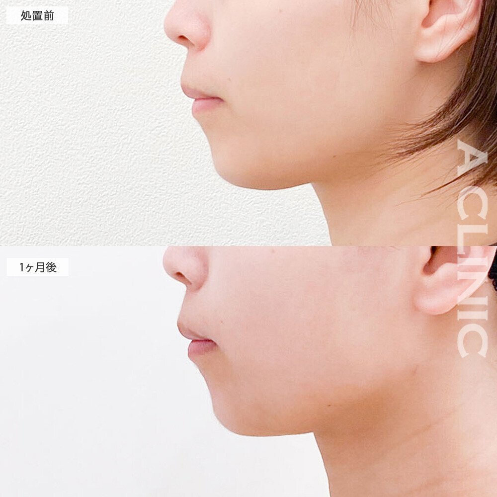 1day小顔脂肪吸引であご下のぷにぷに解消！こちら処置前から2ヶ月半後の症例です(20代女性)