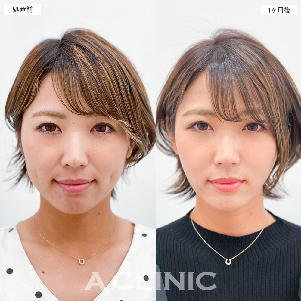 1day小顔脂肪吸引で重たく見えていた顔がスッキリ改善！こちら処置前から2ヶ月後の症例です(30代女性)