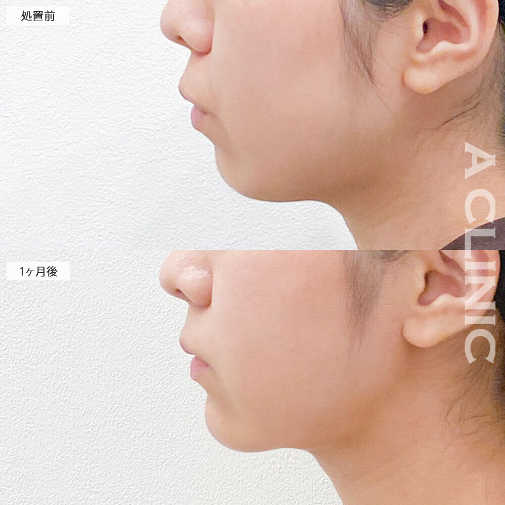 1day小顔脂肪吸引なら落ちにくいあご下の脂肪もこんなにスッキリ！こちら処置前と1ヶ月後の症例です(20代女性)