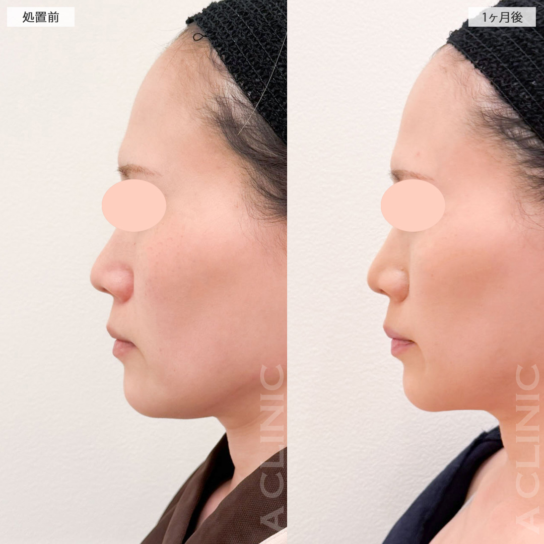 1day小顔脂肪吸引であご下のたるみが無くなりました！処置前から2ヶ月後の症例です(30代女性)